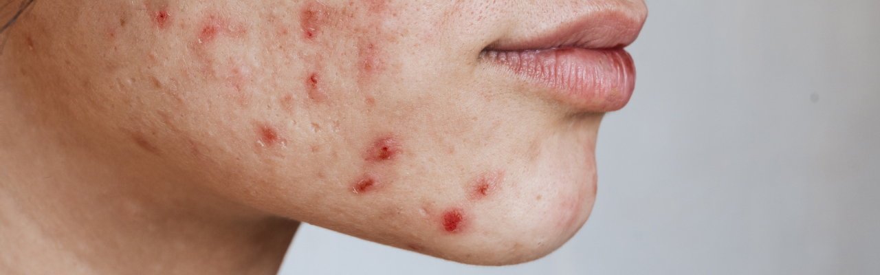 A close up shot of acne on the chin